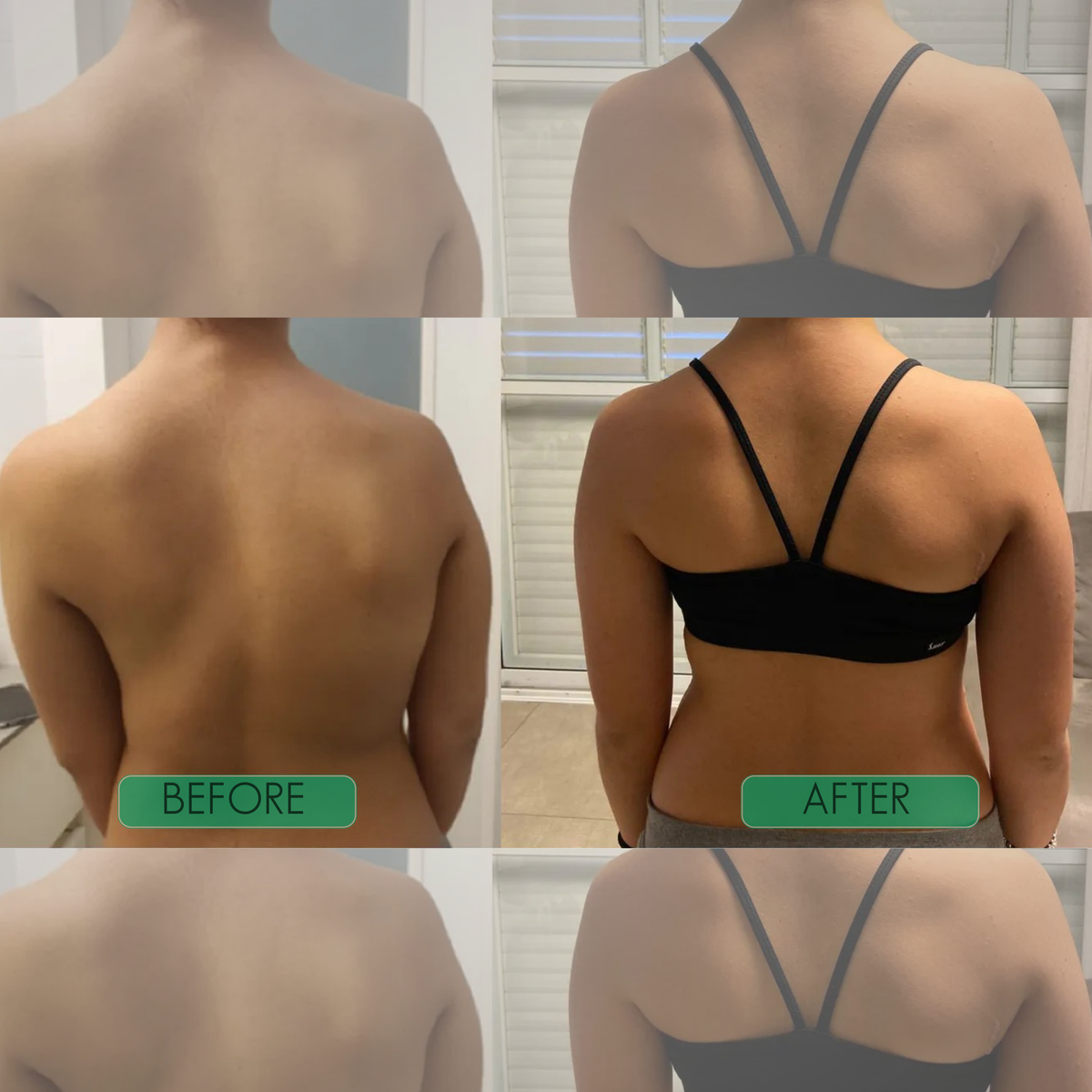 Zenlyft Posture Corrector for Back Pain Relief – Adjustable Upper Back & Shoulder Support Brace
